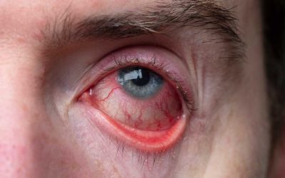 7 Facts About Blepharitis Treatment for Dry Eye Relief