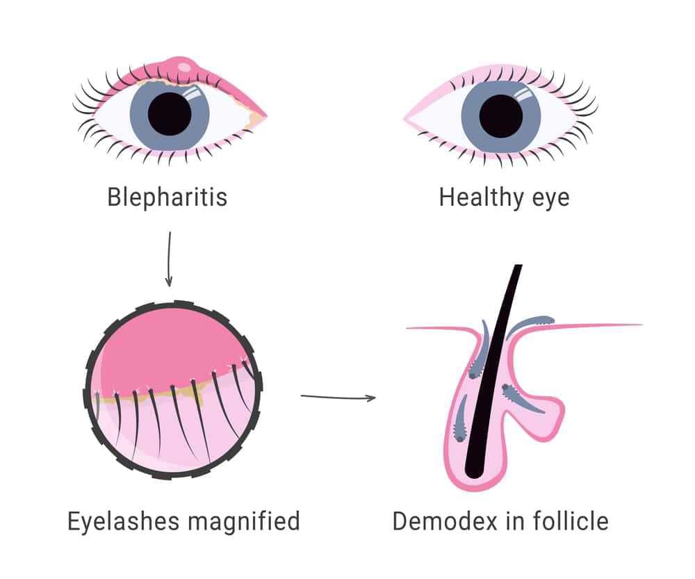 demodex mites in eyelid
