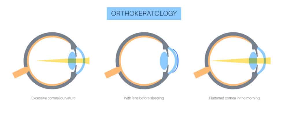 orthokeratology cost